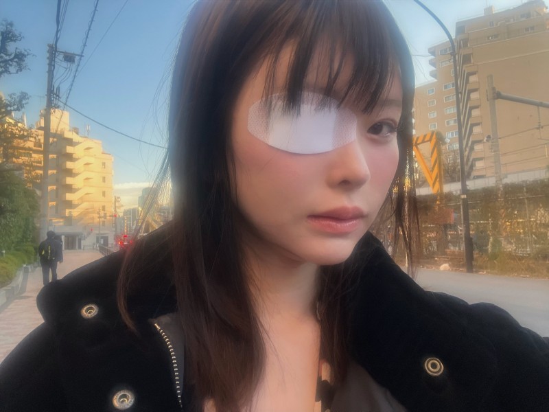 变成独眼龙！松本丽铃(原 明日见未来)被前男友打到受伤